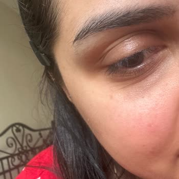 Bakırköy Klinik Göz Altı Işık Dolgusu