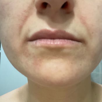 Yves Rocher Ürünleri Yüzümde Alerji Yaptı Ve İlgilenmiyorlar!