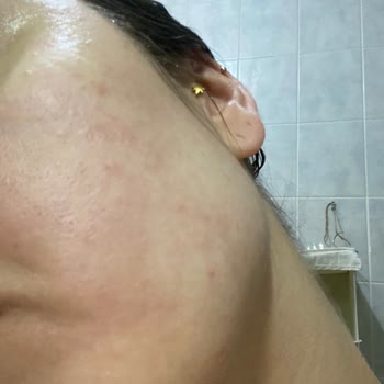 Yves Rocher Ürünleri Yüzümde Alerji Yaptı Ve İlgilenmiyorlar!