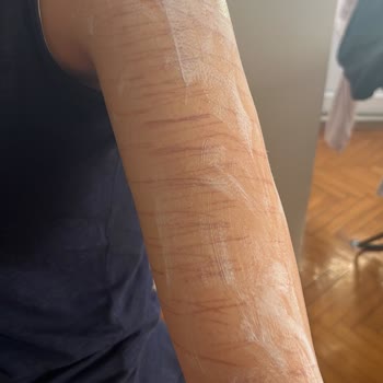 Vip İstanbul Güzellik (Maltepe) Lazer Yanığı