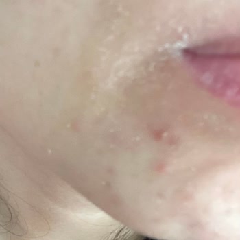 Side Effects of La Roche-Posay Face Wash Included Burning, Redness, and Dryness