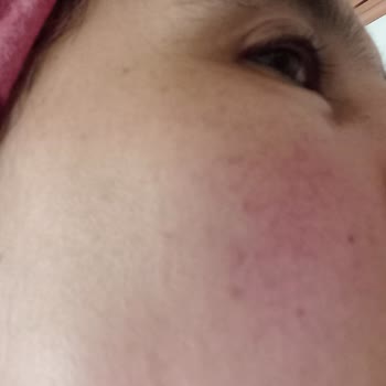 Bioderma Kaşıntı Ve Kızarma