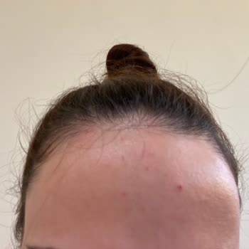 Солнцезащитный крем Missha вызвал акне