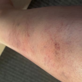 Climed Tedavi Merkezi Bağdat Caddesi Kılcal Damar