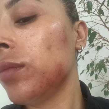 La Roche - Posay Sivilce Kremi Hüsranı