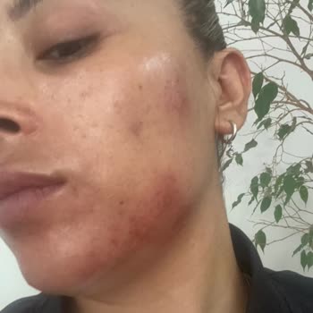 La Roche - Posay Sivilce Kremi Hüsranı