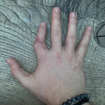 Kartal Dr. Lütfi Kırdar Şehir Hastanesi Doktor Parmağımı Sakat Bıraktı!