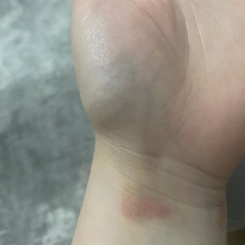 Apple Watch Se Alerji Yaptı