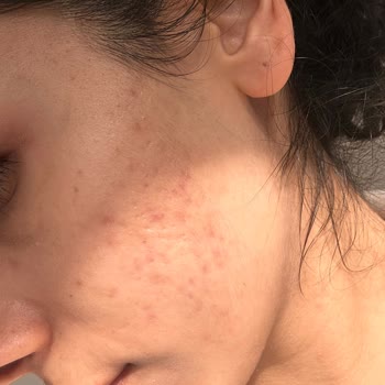 Dr. Neslihan Dolar Sivilce Tedavisi Sonuçsuz Kaldı