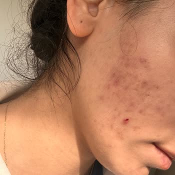 Dr. Neslihan Dolar Sivilce Tedavisi Sonuçsuz Kaldı