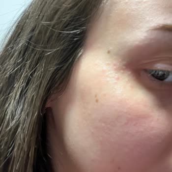 Loccitane Divine Serisi Alerjisi