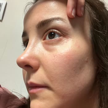 Loccitane Divine Serisi Alerjisi