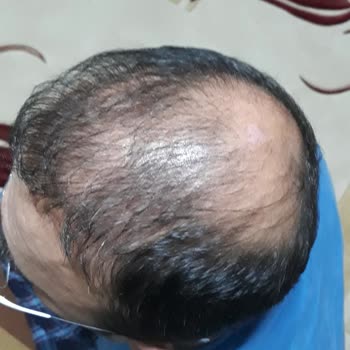 Konhair Saç Ektirme Pişmanlığı