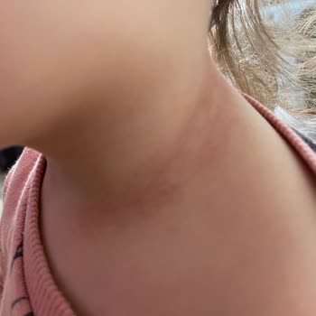 Mustela Nemlendirici Alerji Problemi