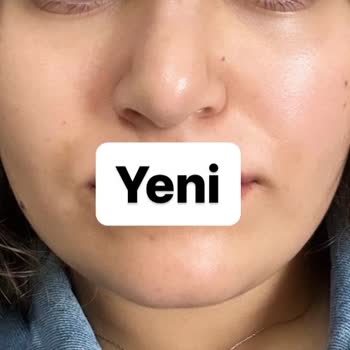 Ankara Bilkent Şehir Hastanesi Revizyon Rinoplasti Daha Kötü Burun