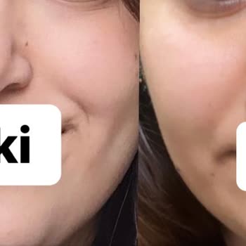 Ankara Bilkent Şehir Hastanesi Revizyon Rinoplasti Daha Kötü Burun