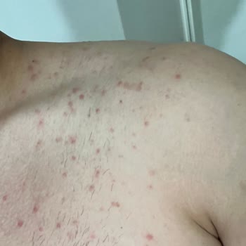 Veet Tüy Dökücü Zarar Verdi, Vücudum Sivilce İçinde