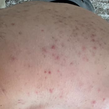 Veet Tüy Dökücü Zarar Verdi, Vücudum Sivilce İçinde