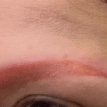 Clinic Ephesus Kırmızı Kaş Mağduru