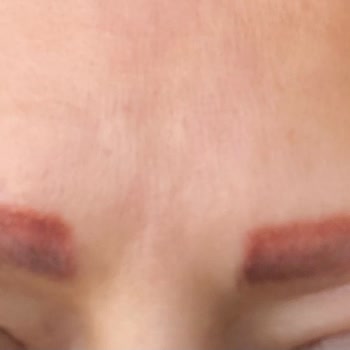 Clinic Ephesus Kırmızı Kaş Mağduru