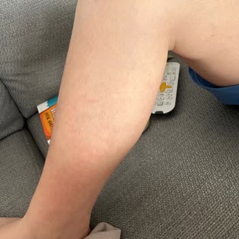 Argivit Smart Vücutta Döküntü