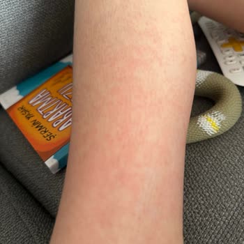 Argivit Smart Vücutta Döküntü