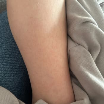 Argivit Smart Vücutta Döküntü