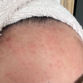 Yves Rocher Organik Sr Saç Ve Vücut Şampuanının Cildimi Mahvetmesi.