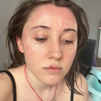 Sebamed'in Oluşturduğu Yanıklar