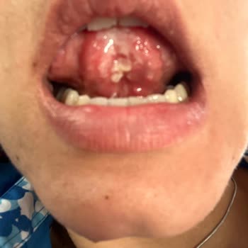 Parodontax Diş Eti Kanaması, Ağız İçi Yaralar