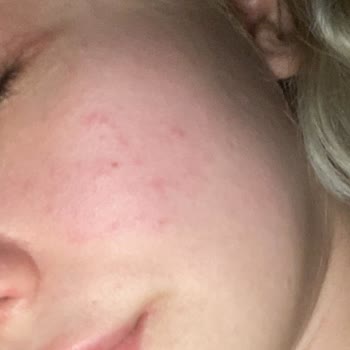 Kiperin Collagen Ağrılı Sivilce Saç Dökülmesi