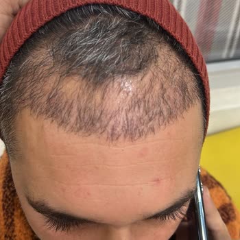 Gaziantep Liv Hospital Sac Ekimi