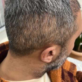 Gaziantep Liv Hospital Sac Ekimi