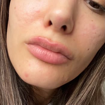 La Roche Posay Gözenek Sıkılaştırıcı Tonik Sivilce Yaptı