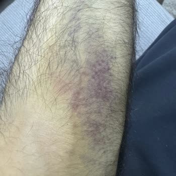 Ataköy Medicana Damar Patlaması