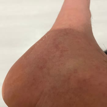 Dermokil Exfoliating Soyulabilir Ayak Maskesi