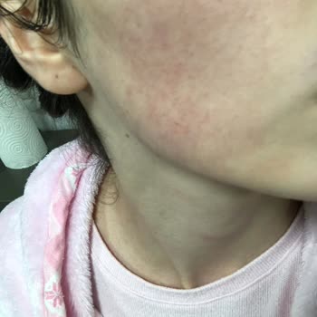 Metromall Missha Çalışanları Yüzünden Cildim Mahvoldu