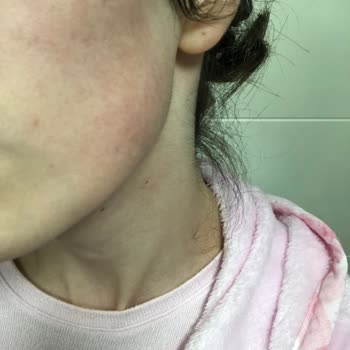 Metromall Missha Çalışanları Yüzünden Cildim Mahvoldu