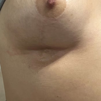 Op. Dr. Ercan Cihandide Göğüs Küçültme Ameliyatı Sonrası Beklenmedik Sonuçlar