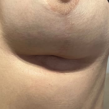 Op. Dr. Ercan Cihandide Göğüs Küçültme Ameliyatı Sonrası Beklenmedik Sonuçlar