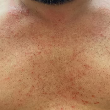 Bioder Spreyden Kaynaklanan Rahatsızlık Deneyimi