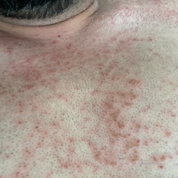 Bioder Spreyden Kaynaklanan Rahatsızlık Deneyimi