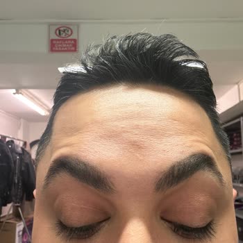 Liva Clinic (Bakırköy) Botoksum Tutmadı Rötuş Olmasına Rağmen