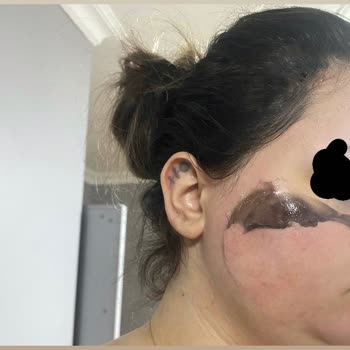 Dermokil Ürünleri Yüzümde Ciddi Anlamda Yanma Ve Kızarıklık Yapıyor