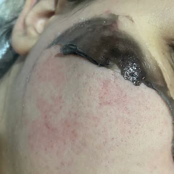 Dermokil Ürünleri Yüzümde Ciddi Anlamda Yanma Ve Kızarıklık Yapıyor