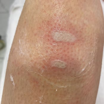 Kayseri Selin Beauty Center Lazerle Bacağımı Yaktı