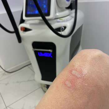 Kayseri Selin Beauty Center Lazerle Bacağımı Yaktı