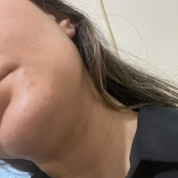 Lancome Lancôme Renergie H. P. N 300 Peptide Krem Yüzümde Sivilce Yaptı