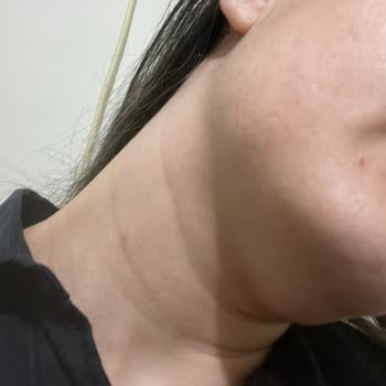 Lancome Lancôme Renergie H. P. N 300 Peptide Krem Yüzümde Sivilce Yaptı