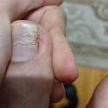 Climed Tedavi Merkezi Climed - Tırnak Batma Ameliyatı Başarısız!